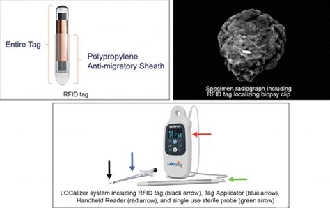 rfid breast localization system|breast radio frequency identification.